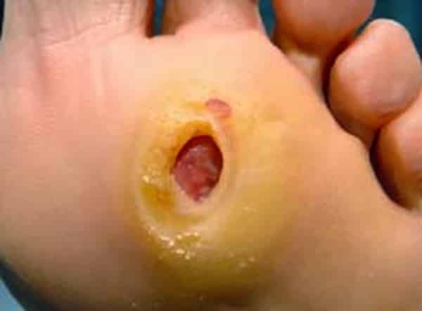 cuidados del pie diabetico cuidados del pie diabetico