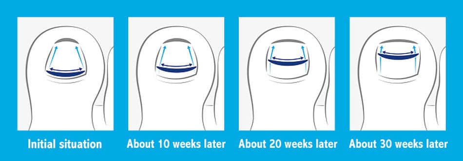 evolución tratamiento con brackets en uñas pie